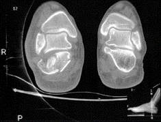 Inferior Calcaneal Spur